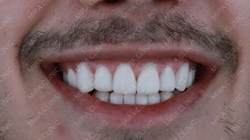 What Hollywood Smile Planning Really Means